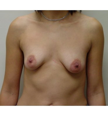 before breast implant